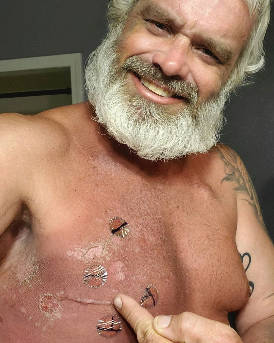 Our Warrior Wednesday spotlight, Zac Yarbrough, shows off his scars on his chest.